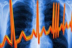 Bihotzaren arritmia osteokondrosiarentzat
