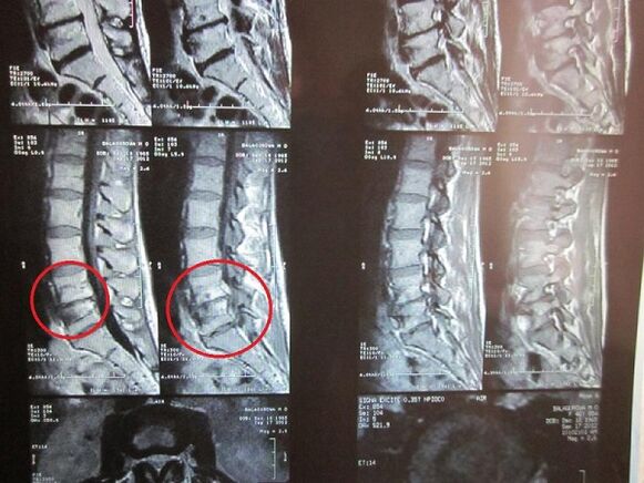 Osteokonondrosaren zerbikalaren diagnostikoa
