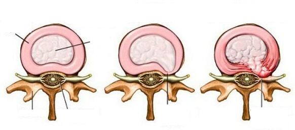 hernia intervertebral untziko osteochondrosia
