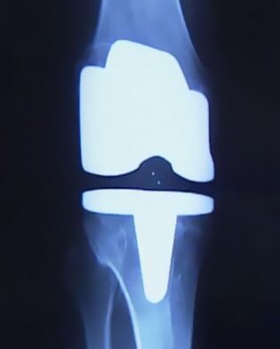 X -Ray Belaunaren argazkia protesi artifizial batekin, artikulazioa aldatu ondoren